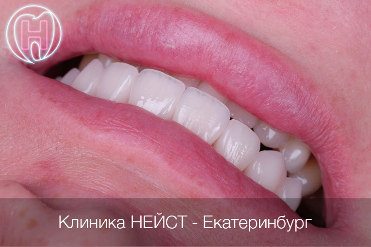 Натуральные керамические виниры цвет Блич 4 (Bleach 4)