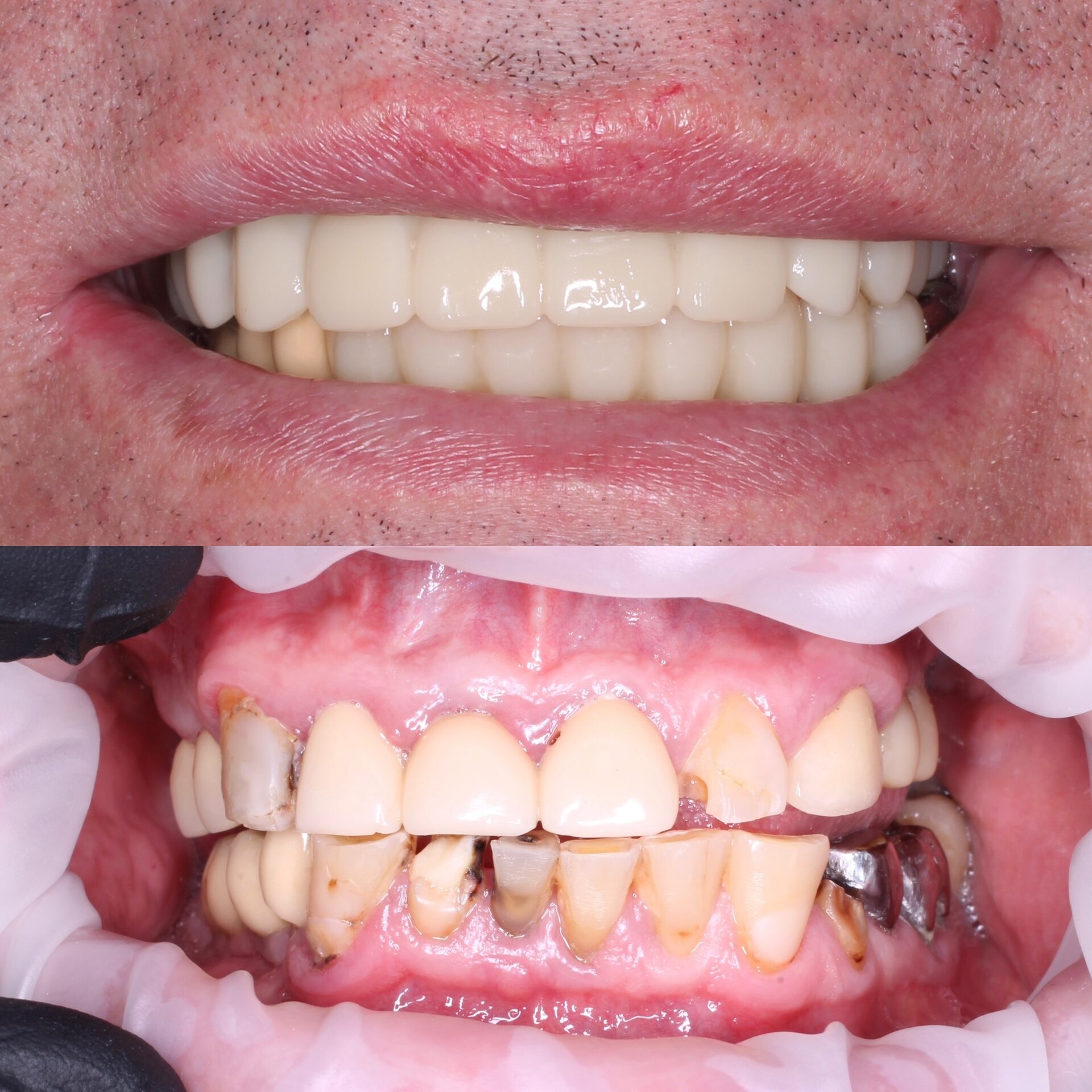 имплантация зубов чебоксары,имплантация зубов йошкар-ола,тотальная реабилитация на 6 имплантатах,протез несъемный в чебоксарах