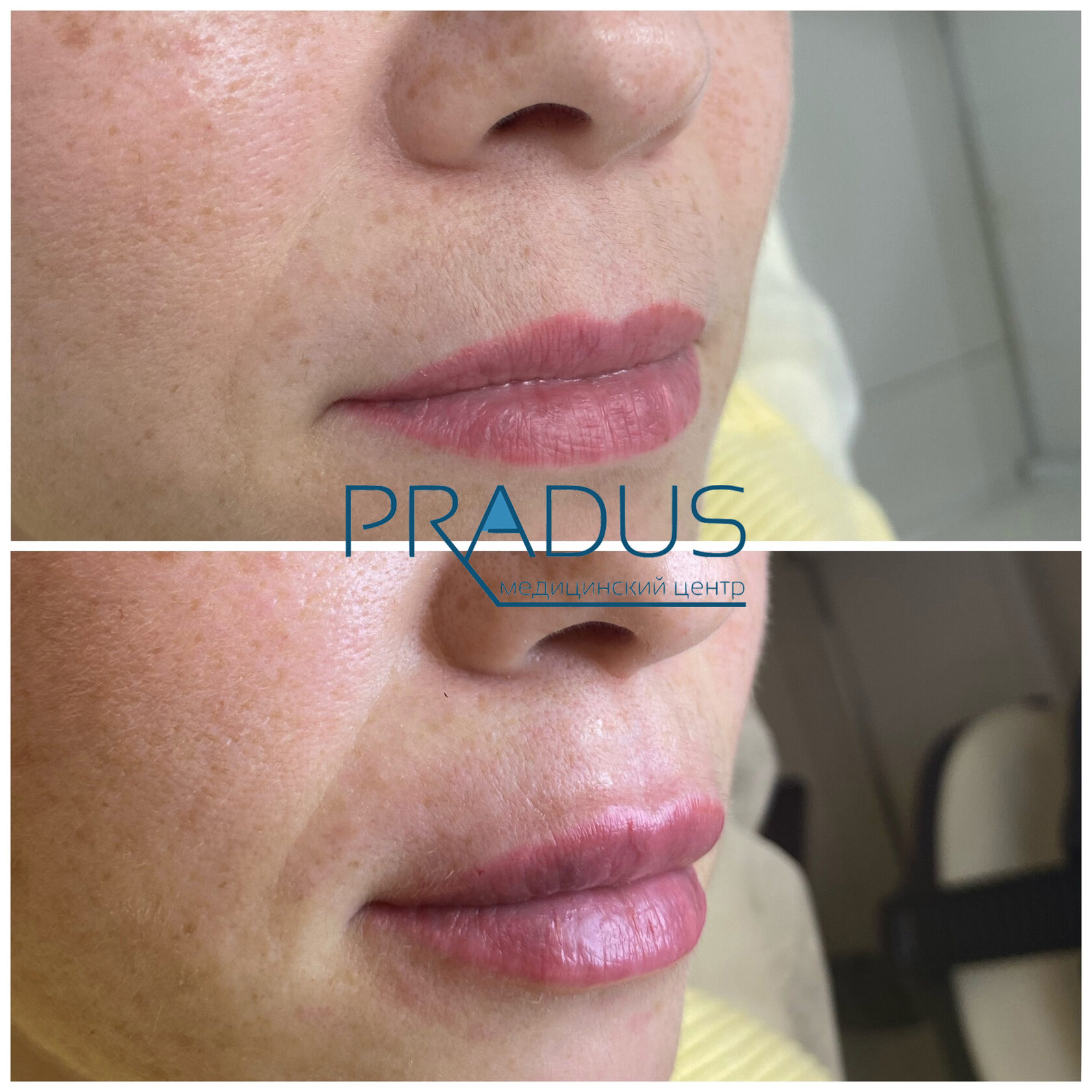 До и после контурной пластики губ. Увеличение объёма без утяжеления. PradusCOSMO, Васильевский остров