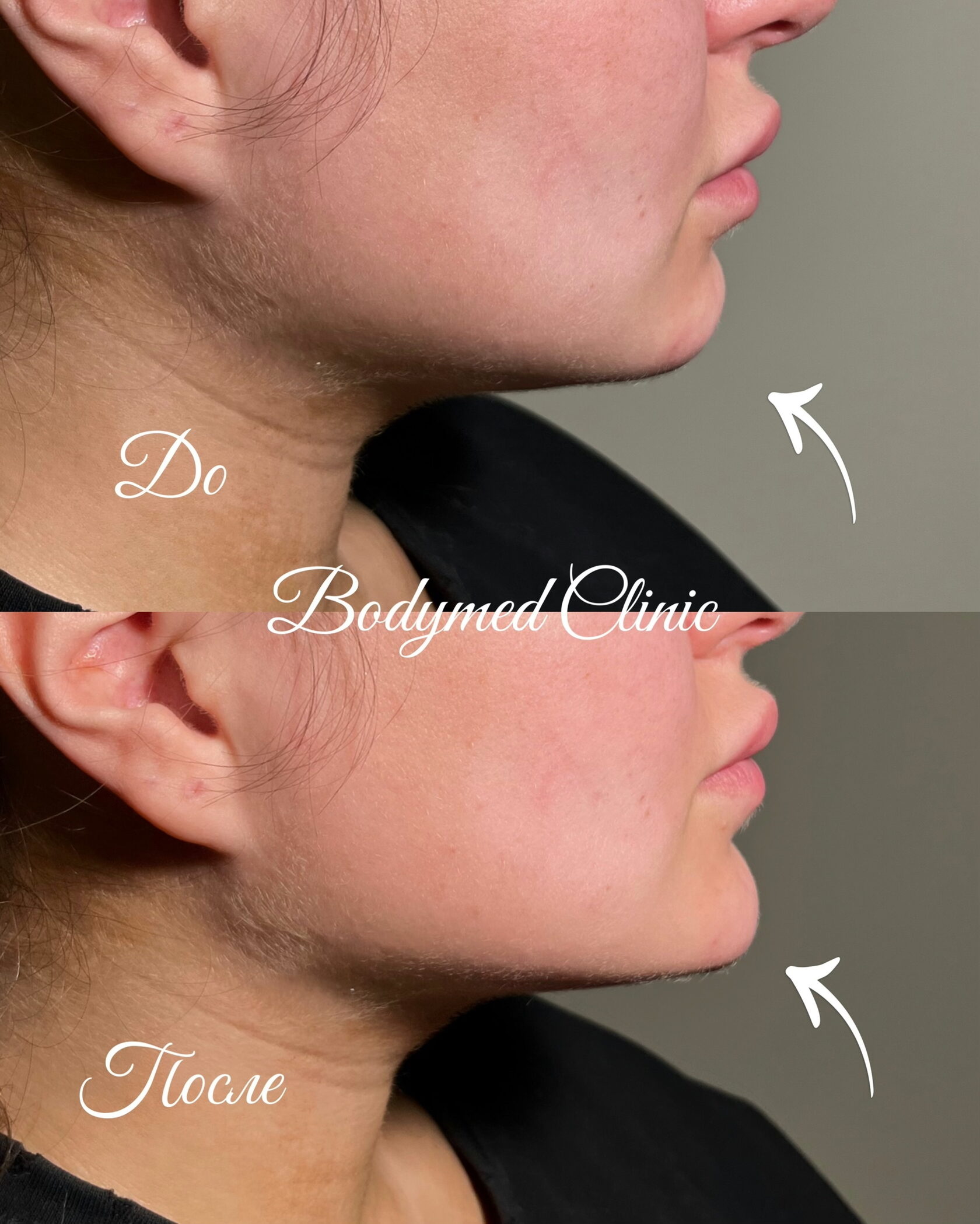 Full face коррекция лица в клинике BODYMED