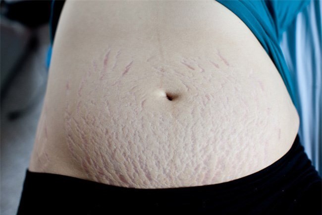 Как убрать растяжки на теле и причины их появления?