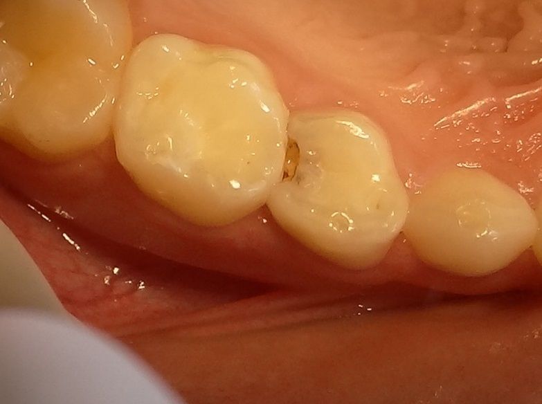 Профилактика и лечение кариеса на передних зубах