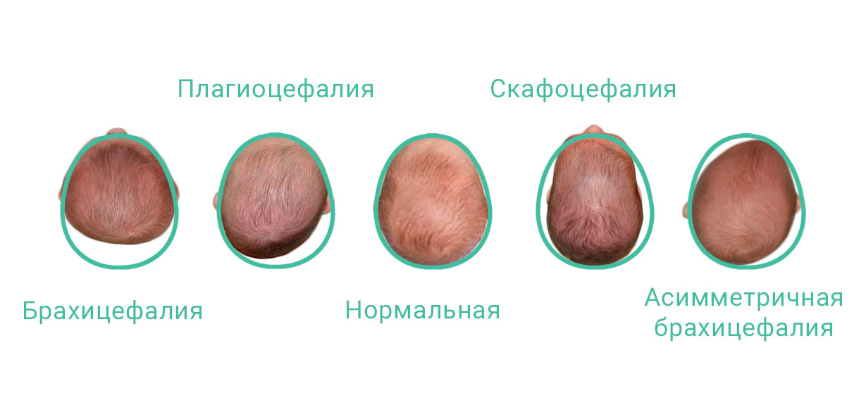 Нормальная головка. Долихоцефалическая, долихоцефалическая форма головы. Долихоцефалическая форма головы новорожденного. Долихоцефалическая форма головы это норма?. Брахицефалическая форма головы новорожденного.