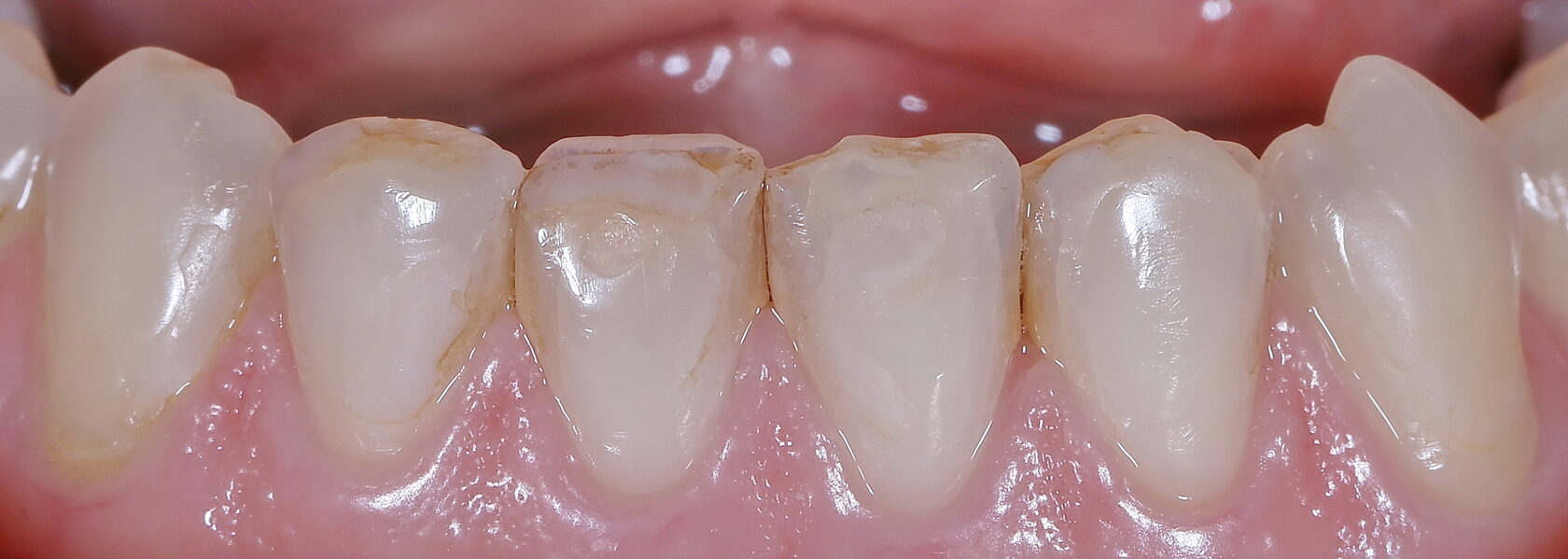 Что такое художественная реставрация зубов ▶️ Eurodent
