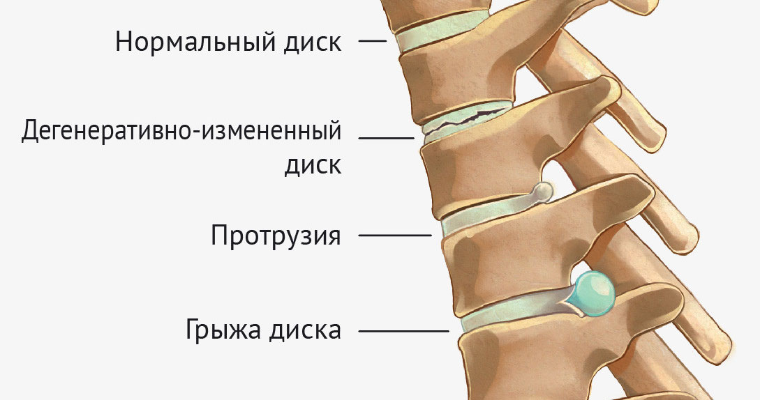 Протрузии межпозвонковых дисков фото