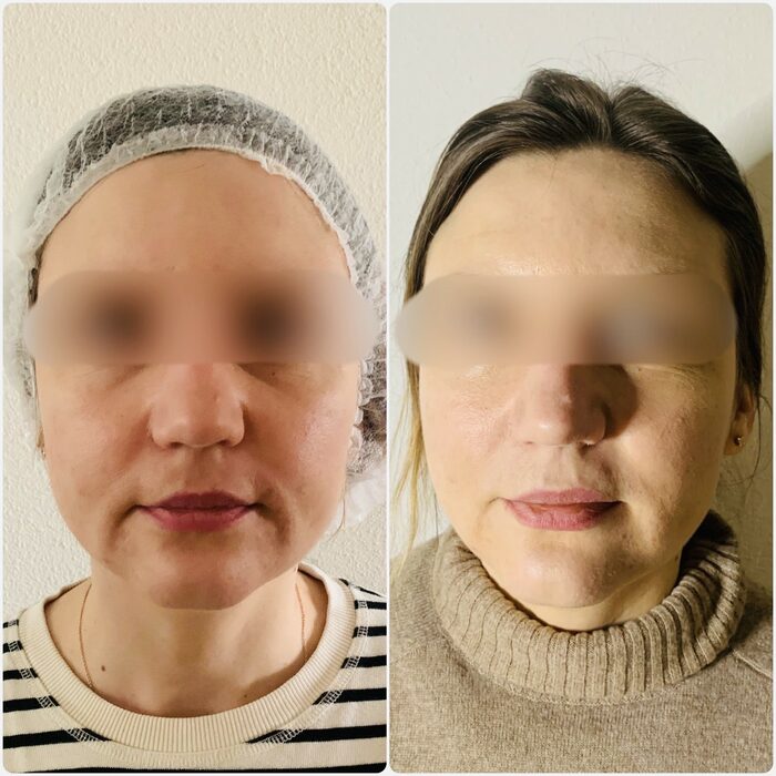 Ultraformer: non-invasive SMAS lifting - Beauty Concept Moscow