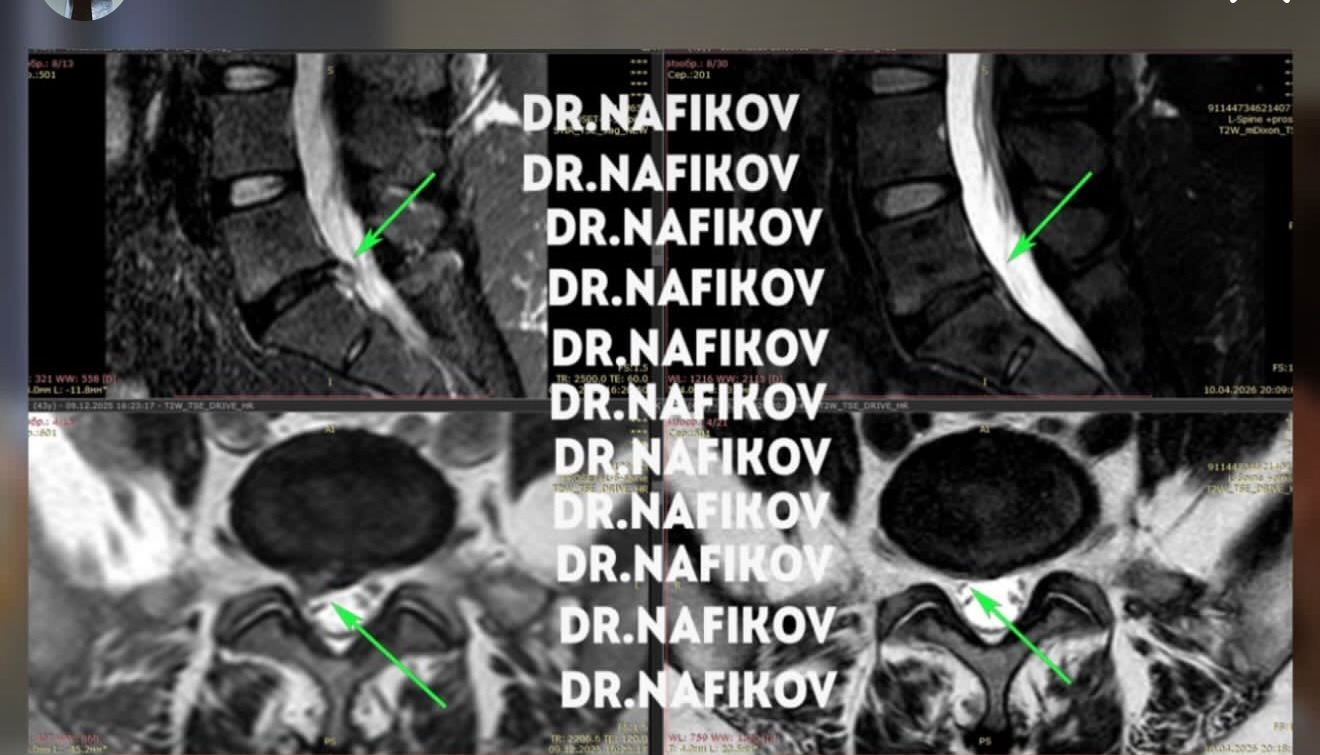 МРТ до и после лечения, Пациент Ю., 43 года
