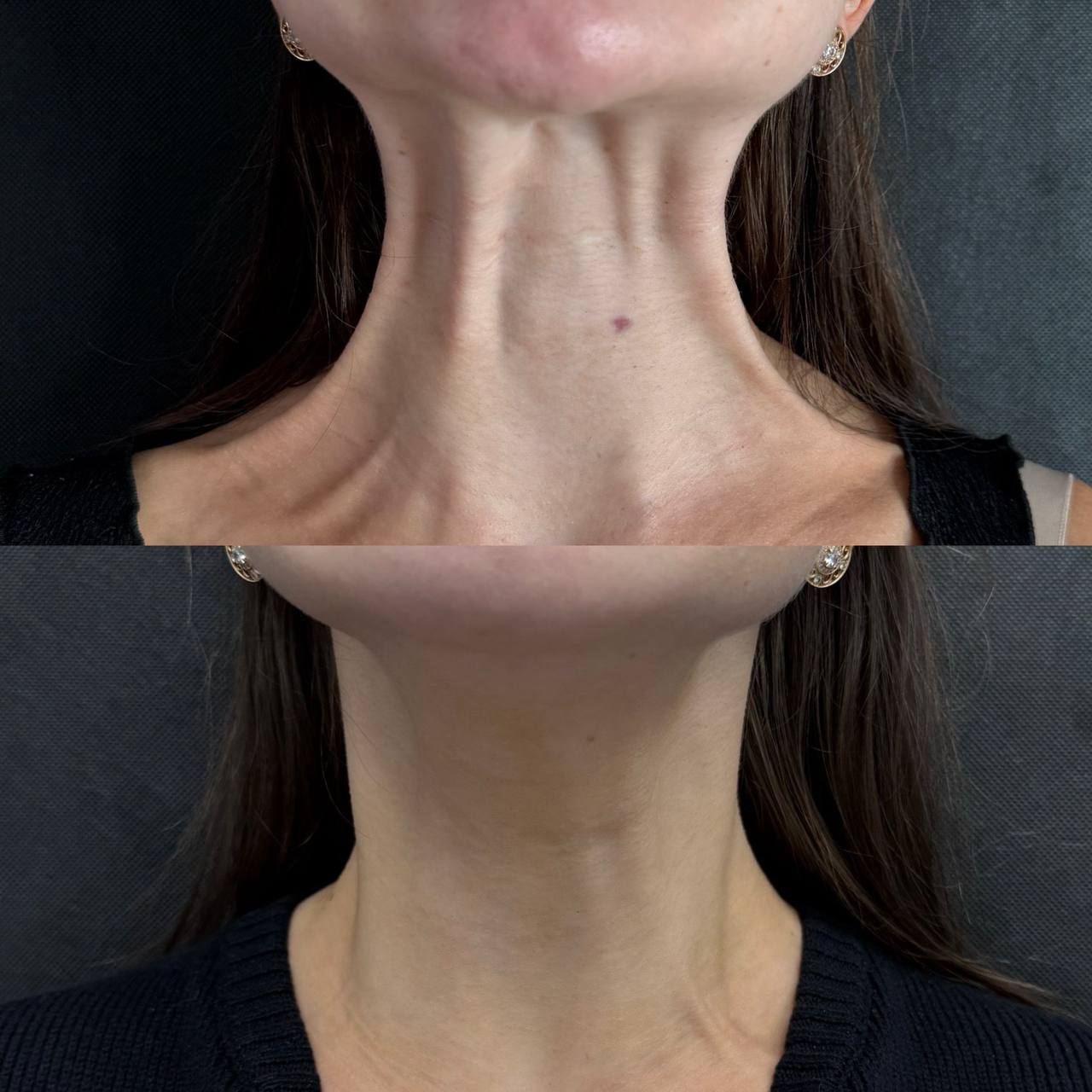 До и после ботокса в Blvck Clinic Питер