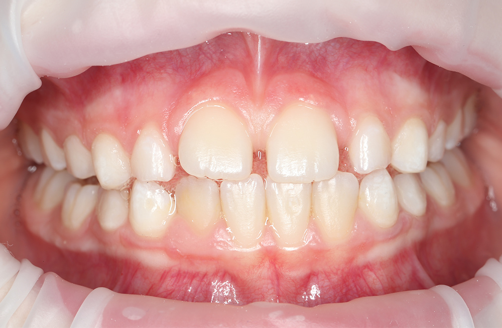 Профессиональная гигиена и обучение домашнему уходу за зубами с помощью технологии Air Flow