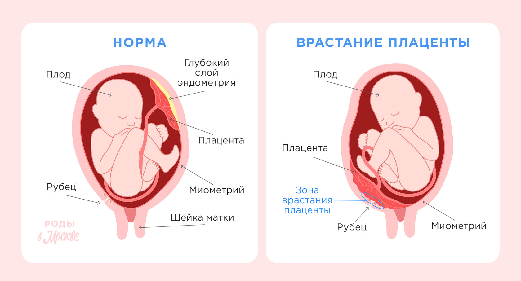 Роды с врастанием плаценты: все возможно, главное, подготовка!