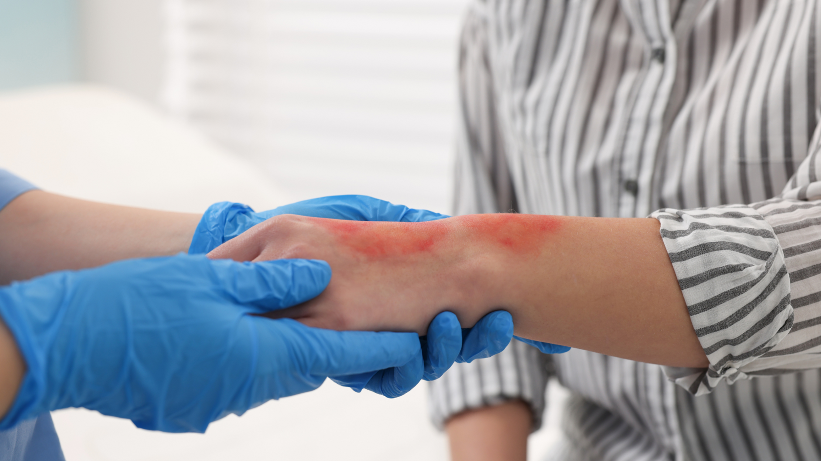 Мероприятия первой помощи при ожогах: почему важно действовать сразу