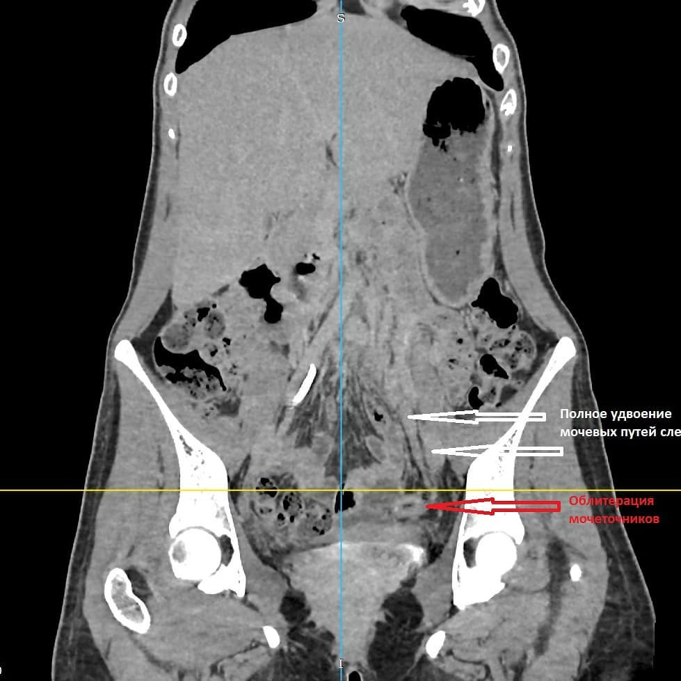 Облитерация синусов. Облитерация синуса легкого. Полное удвоение мочевых путей. Стриктура мочеточника МСКТ. Облитерация латерального синуса справа.
