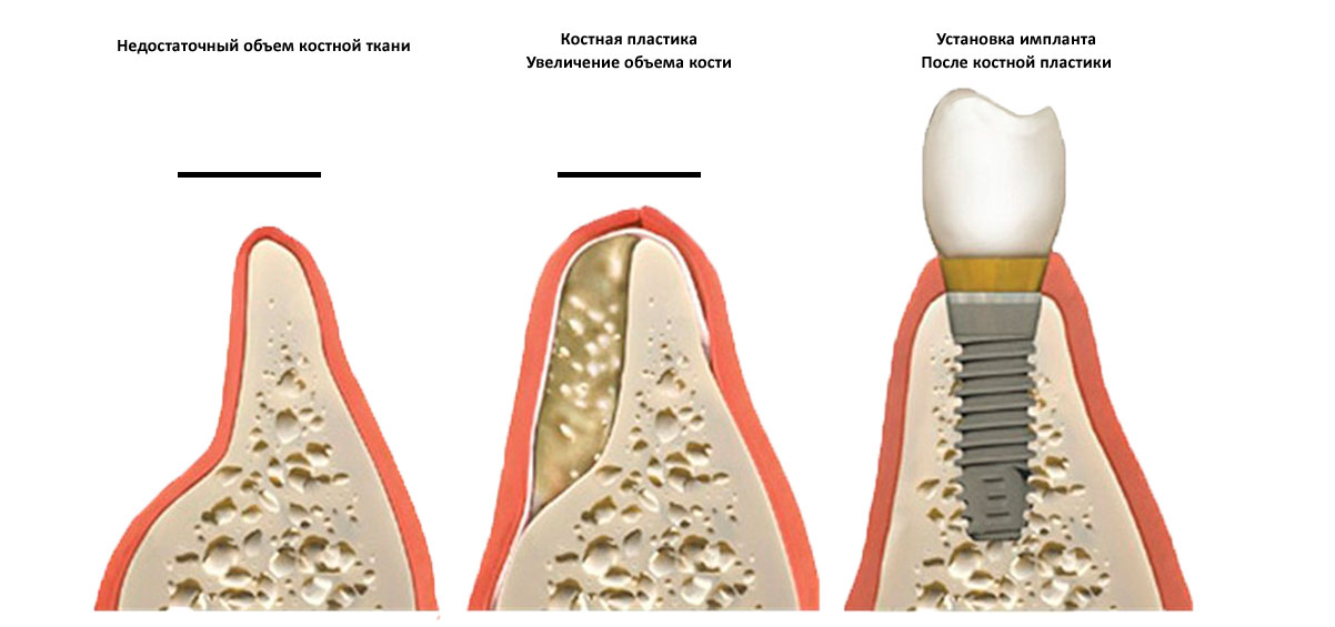 Наращивание кости отзыв