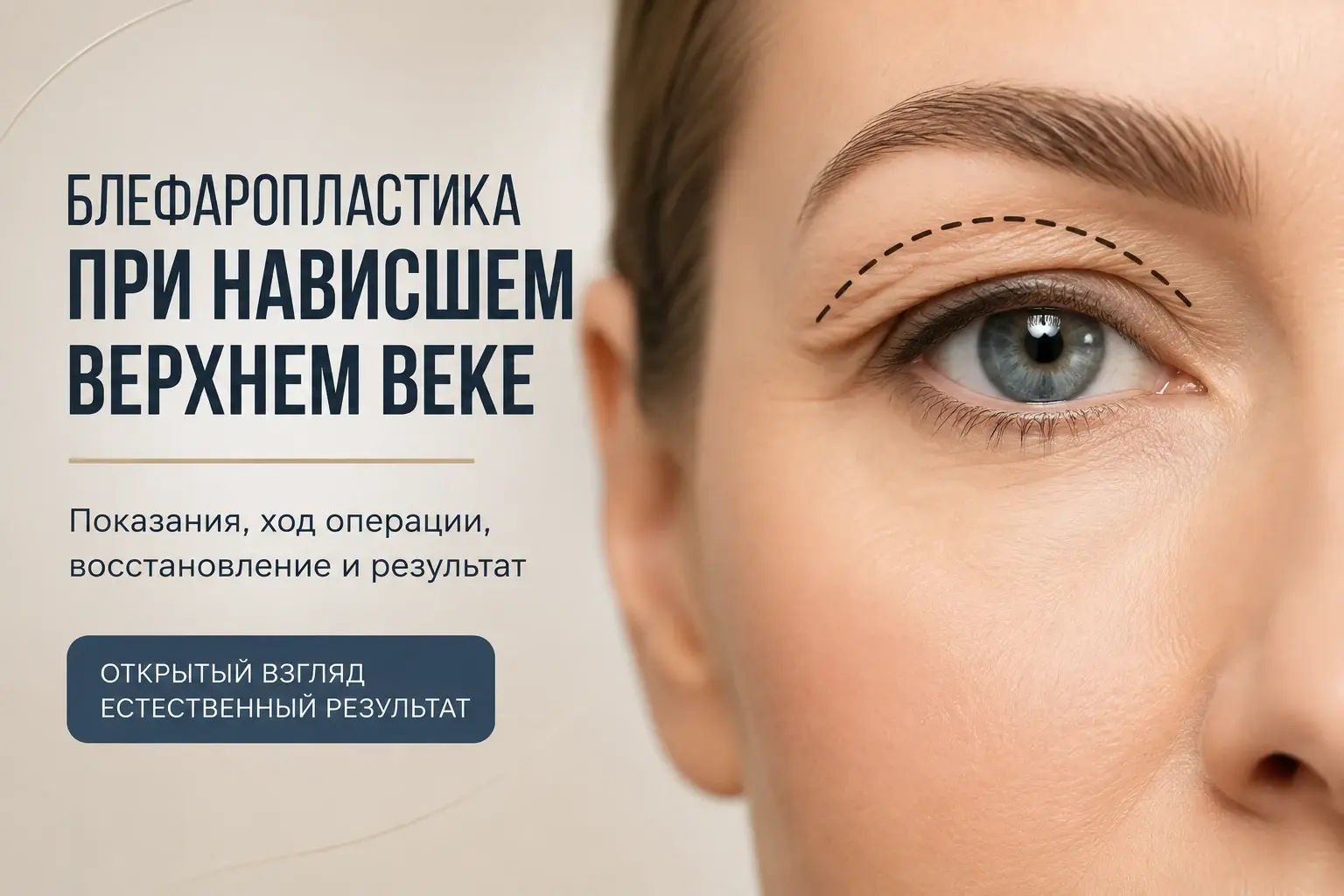 Блефаропластика при нависшем верхнем веке
