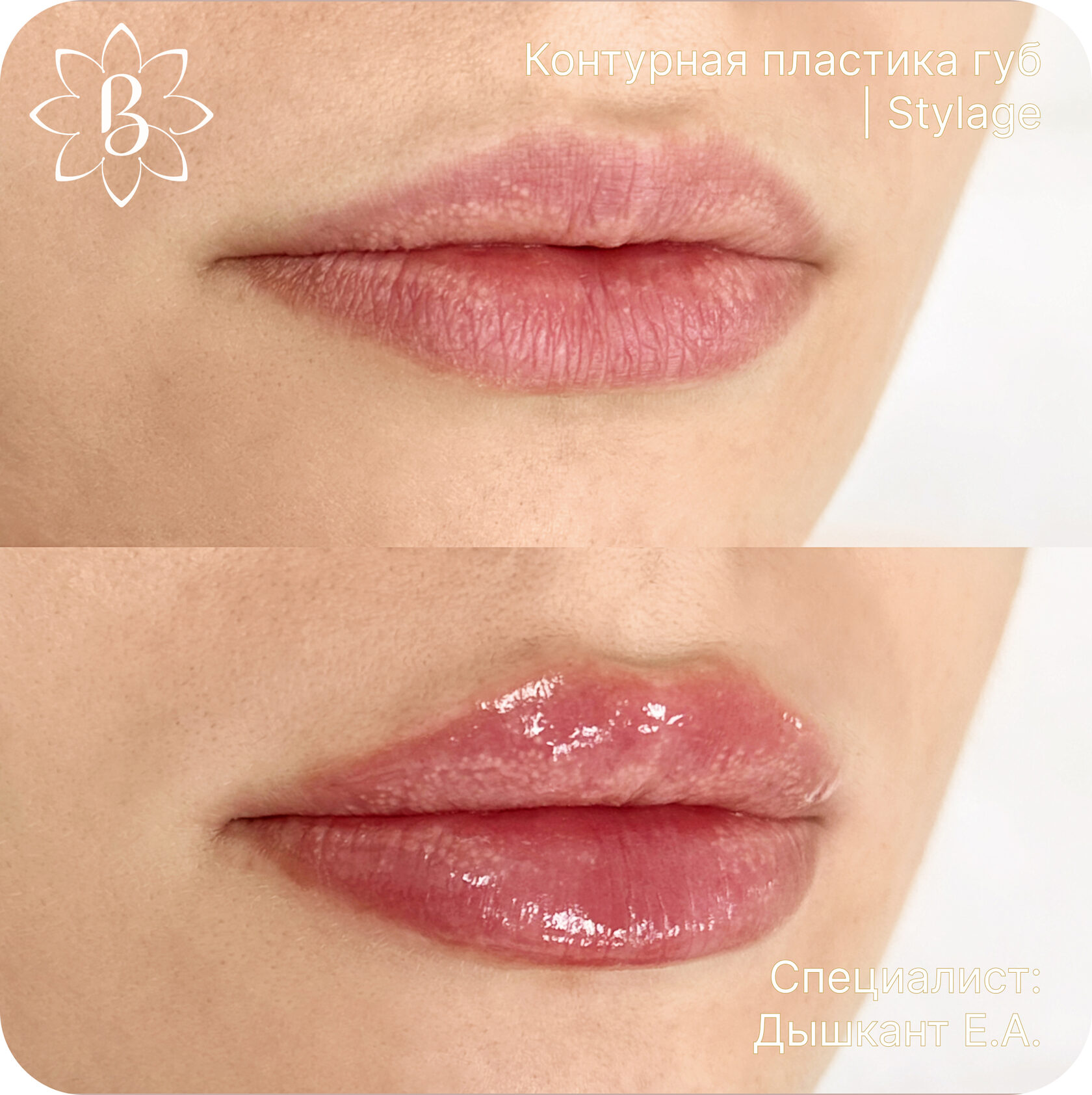 Александритовая лазерная эпиляция