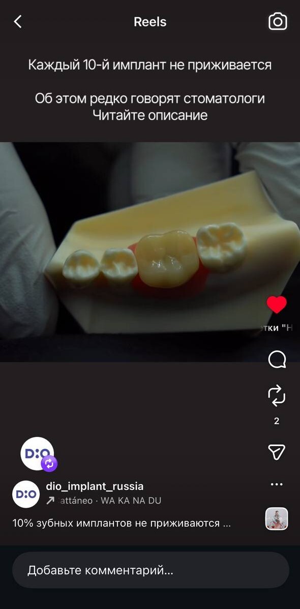 DIO Implant