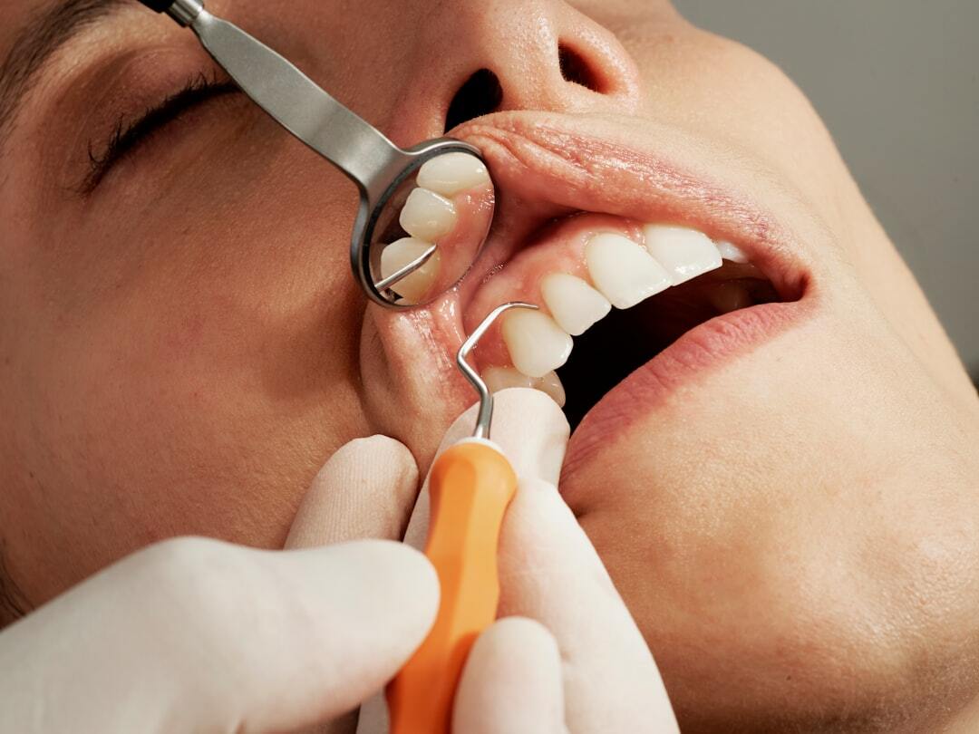 Беспокоит чувствительный зуб после реставрации - стоматология «Голливуд» в Томске