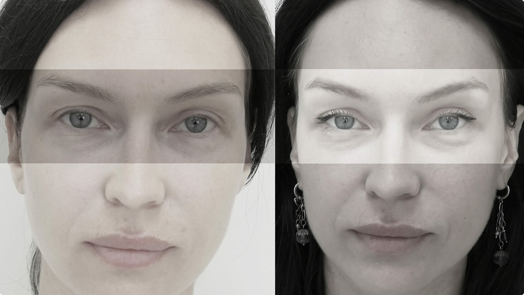 Блефаропластика фото до и после разные глаза