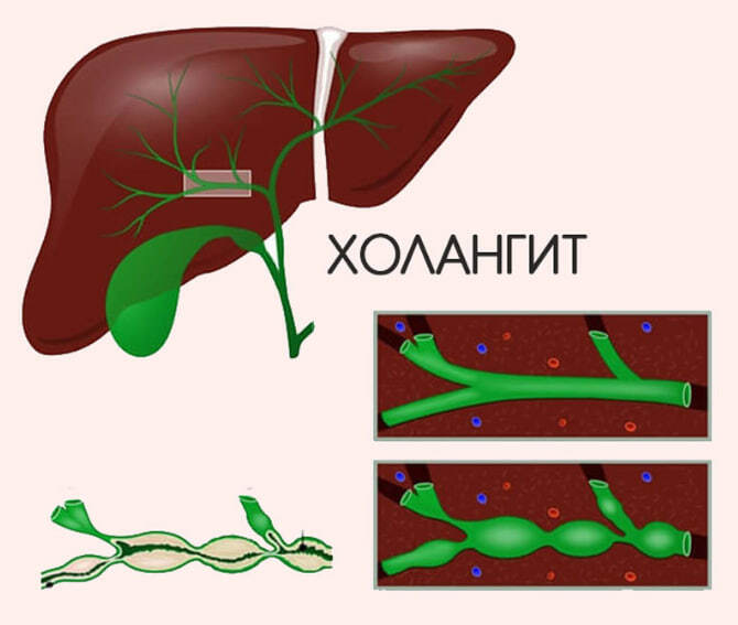 Холангит желчных протоков: причины, симптомы, лечение воспаления