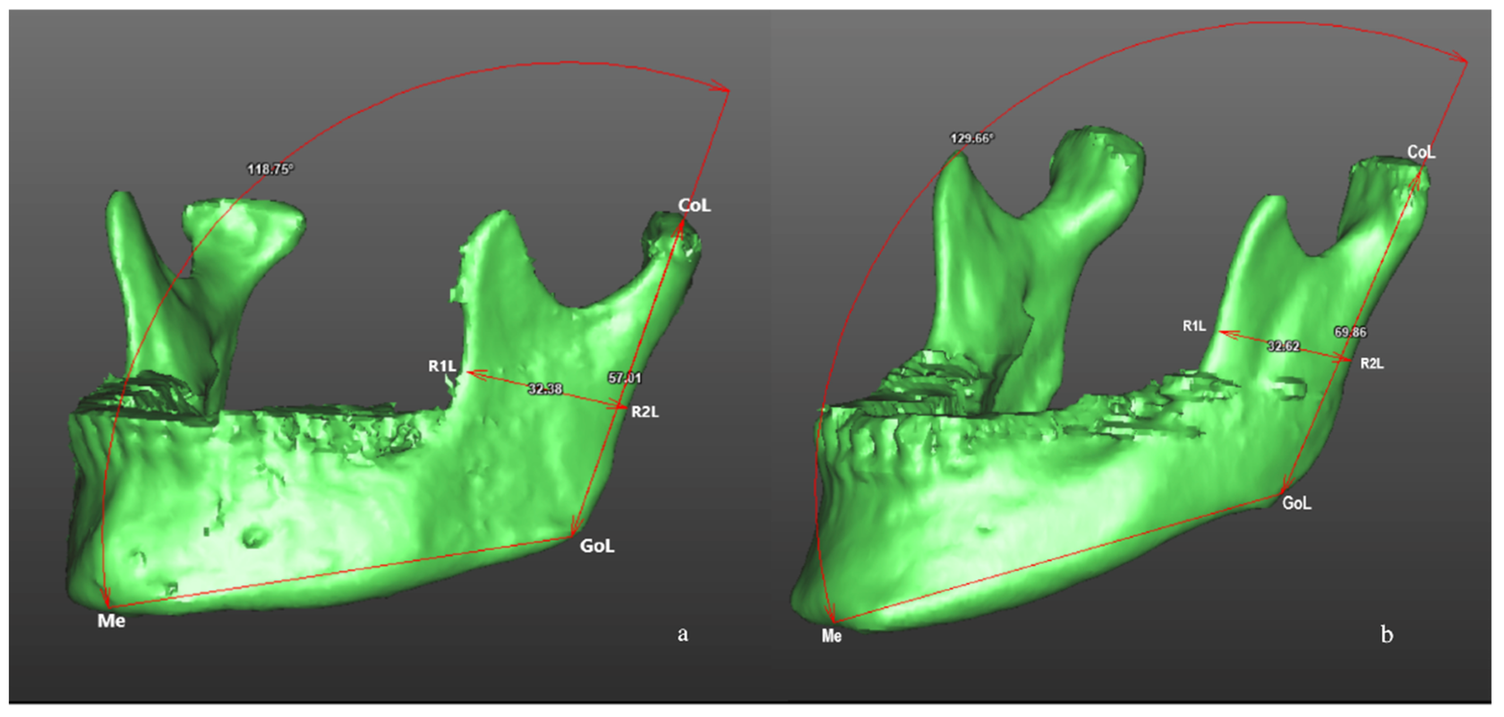 3D-визуалізація нижньої щелепи