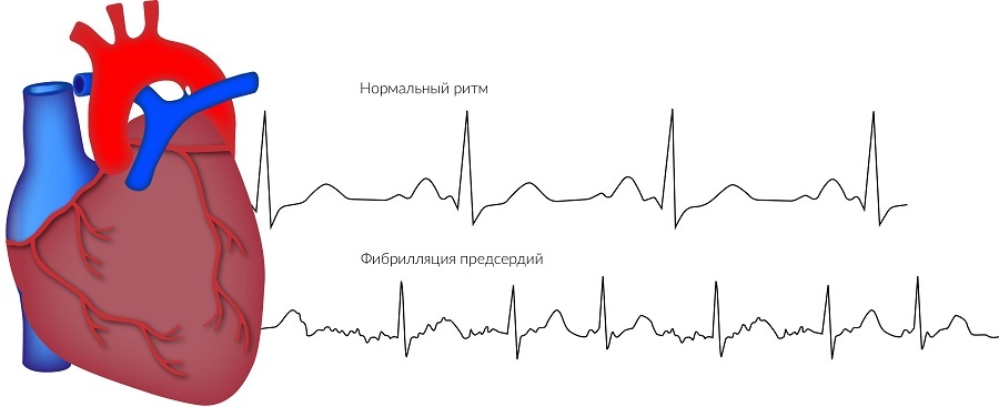 Фибрилляция предсердий картинки