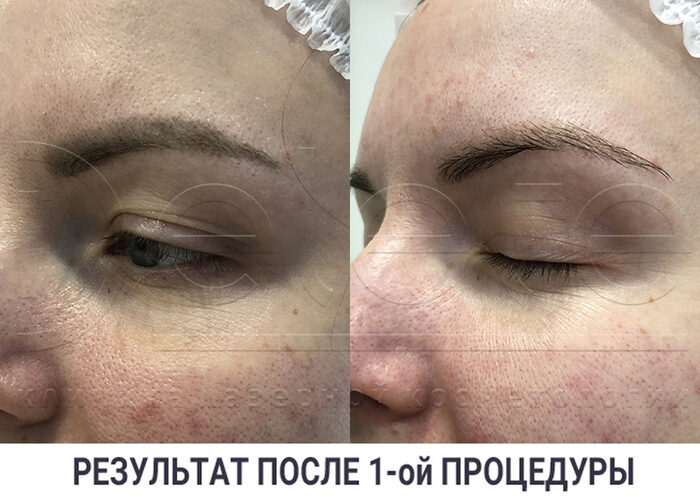 Отек после лазерного удаления татуажа бровей что делать - 95 фото