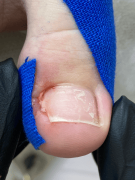 Обработка и тейпирование вросшего ногтя