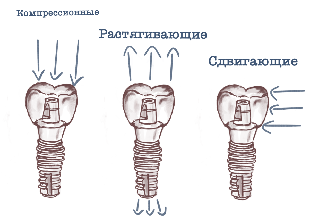 Имплант схема. Срок службы зубных имплантов. Компрессионный имплант зуба. Кортикальный или компрессионный имплант зуба отличия.