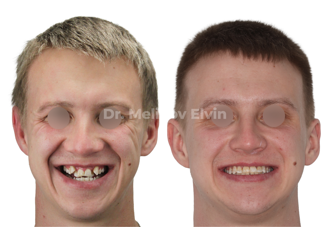 До и после расширения верхней челюсти