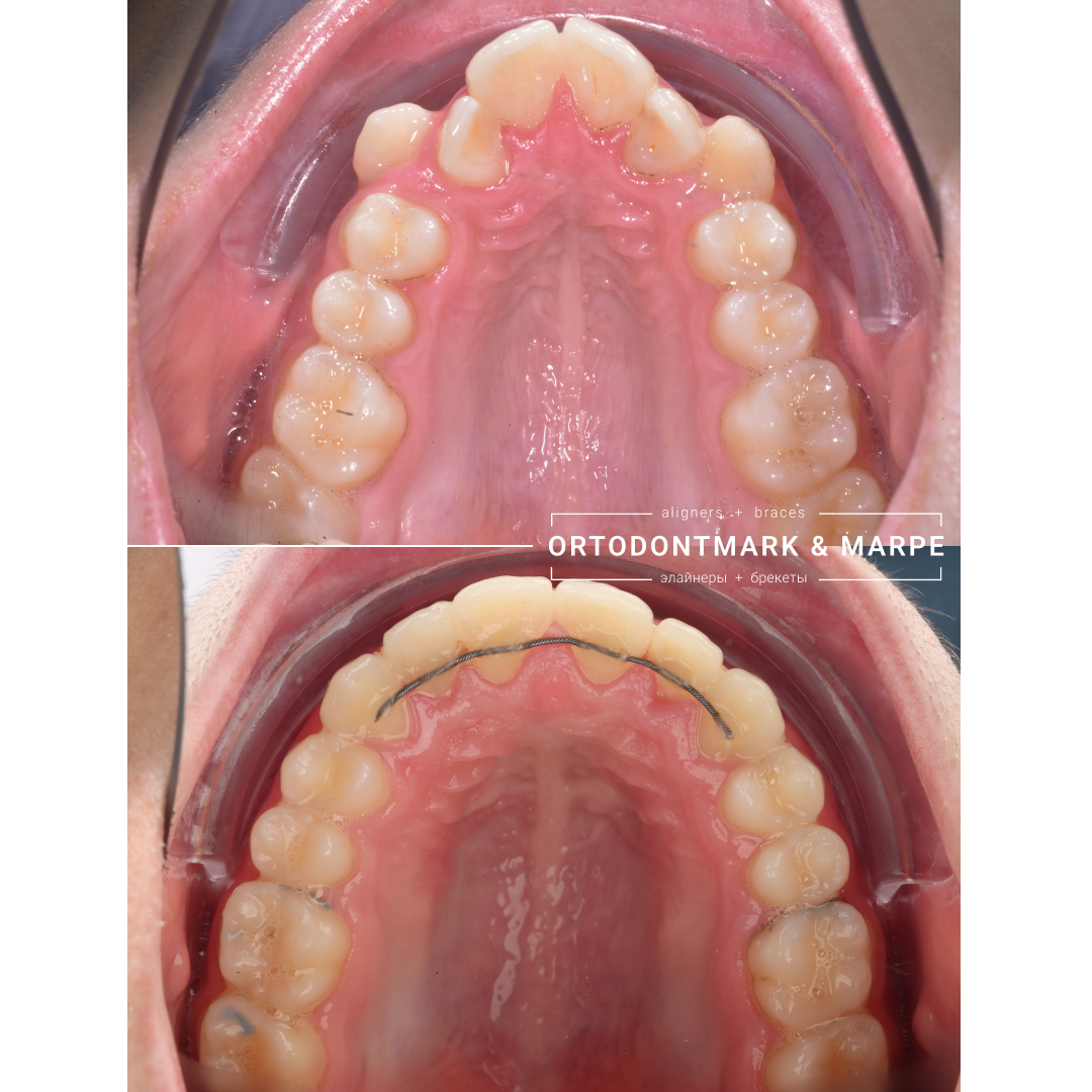 MARPE case result 1