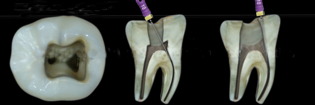Чистка каналов зуба и временная пломба