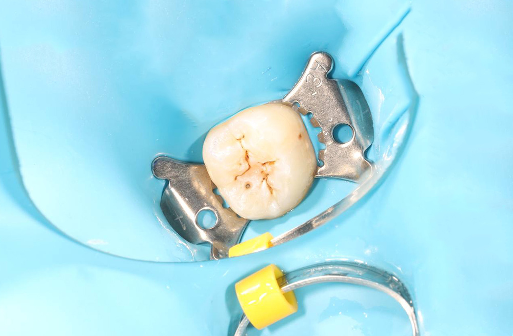 Устранение чувствительности к сладкому путем лечения кариеса дентина и новой реставрации