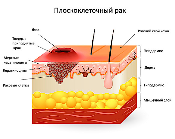 Плоскоклеточный рак вульвы фото