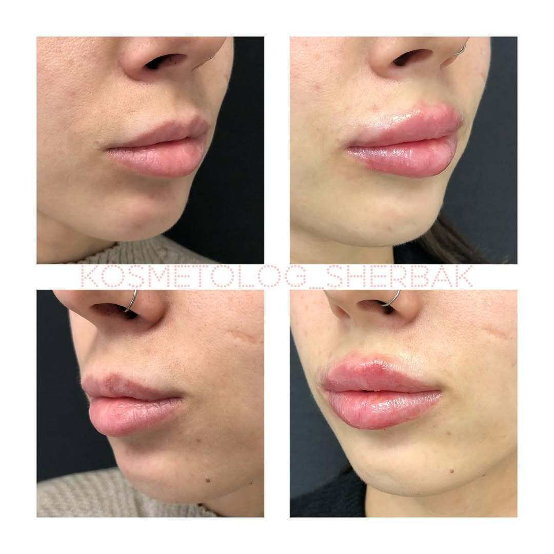 До и после контурной пластики губ. Увеличение объёма без утяжеления. PradusCOSMO, Васильевский остров