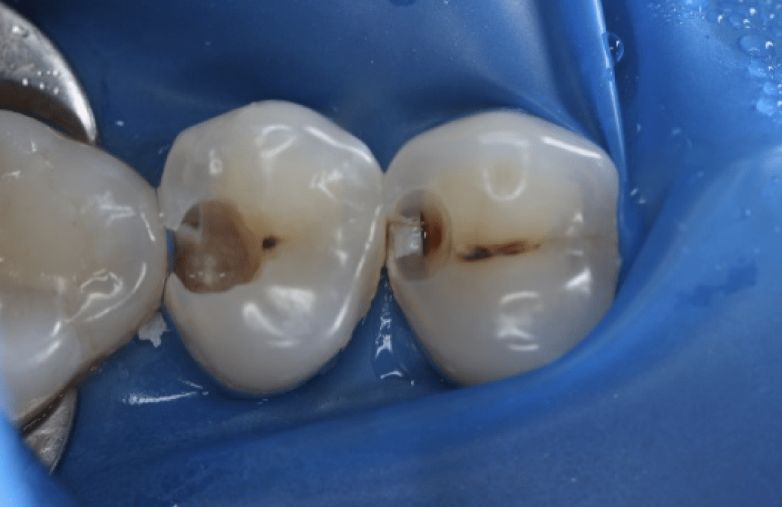 Лечение кариеса зуба - стоматология у метро Раменки