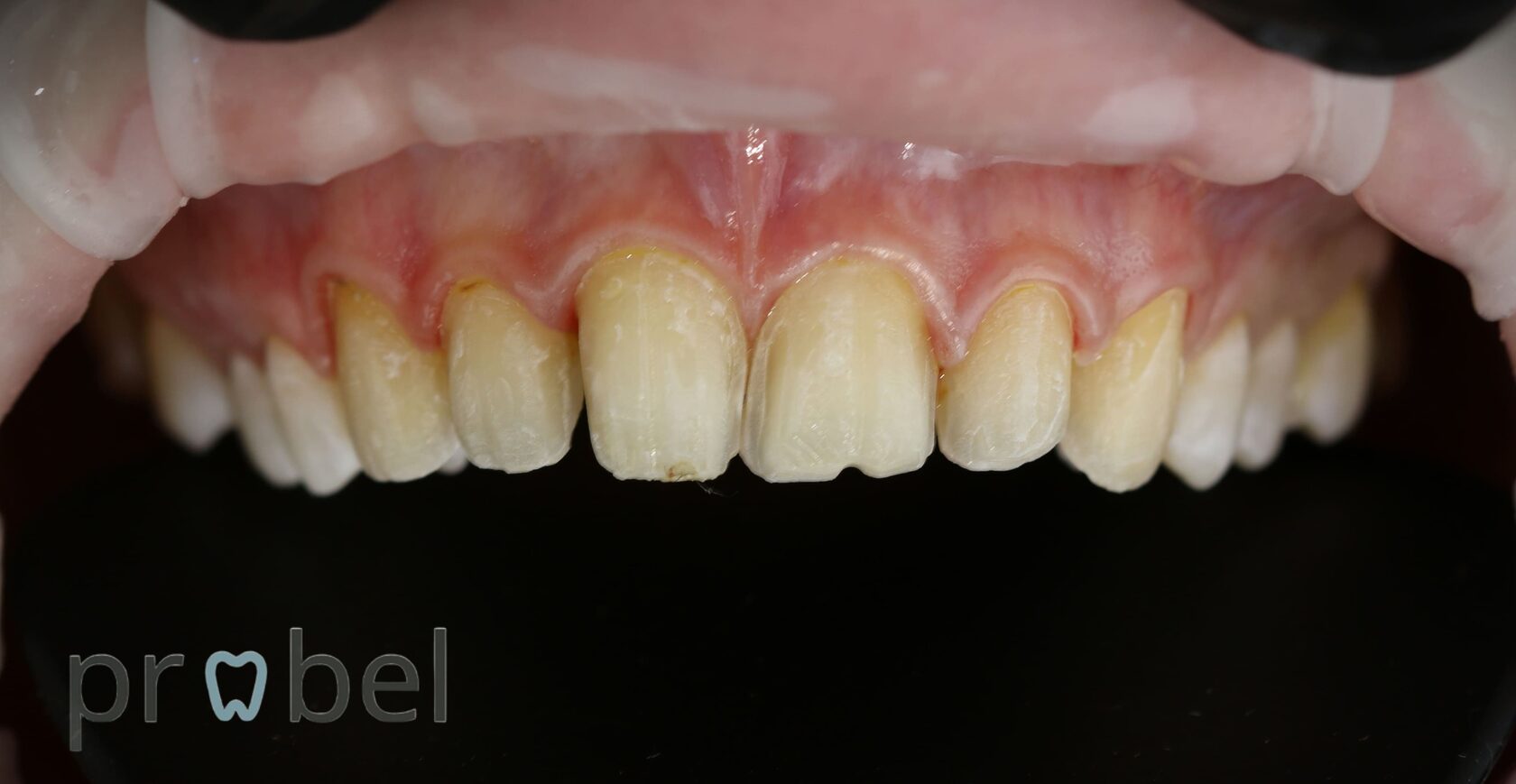 лечение стираемости зубов