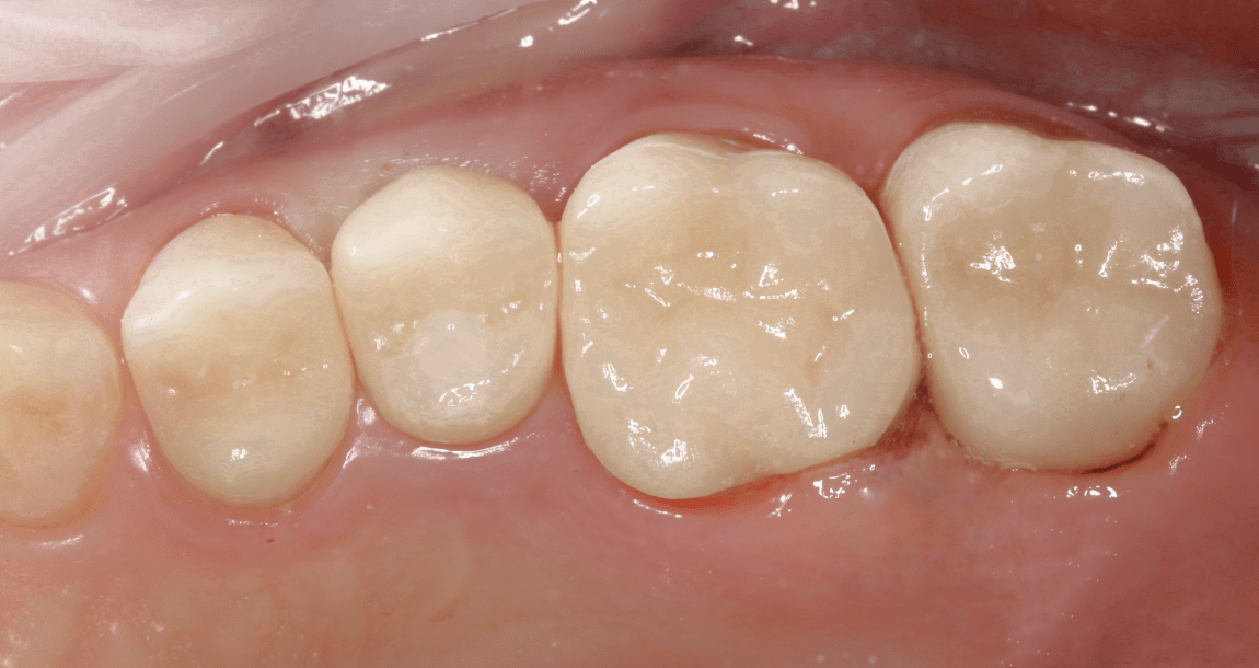 Имплантация одного зуба для предотвращения атрофии кости и смещения зубов