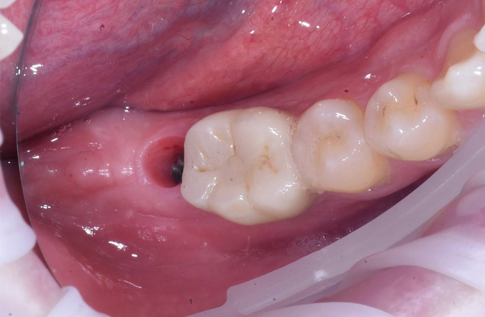 Имплантация нижнего моляра системой Osstem с протезированием циркониевой коронкой