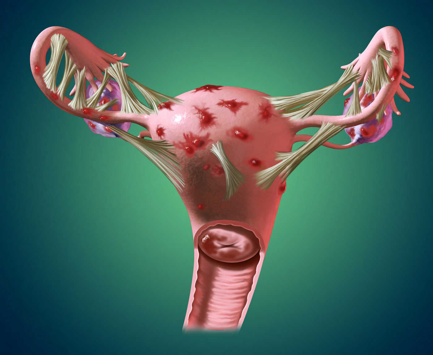 Лапароскопия при эндометриозе: лапароскопическое удаление очагов в матке