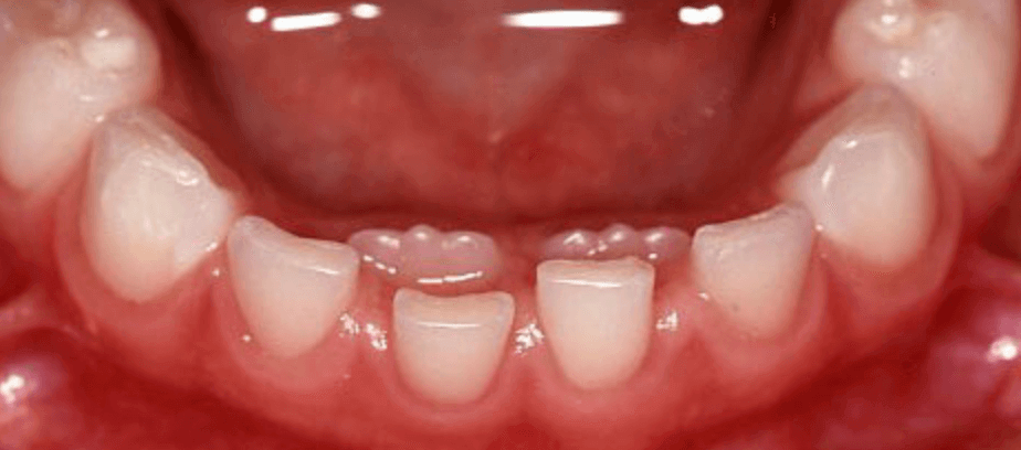 Какие постоянные зубы у детей фото