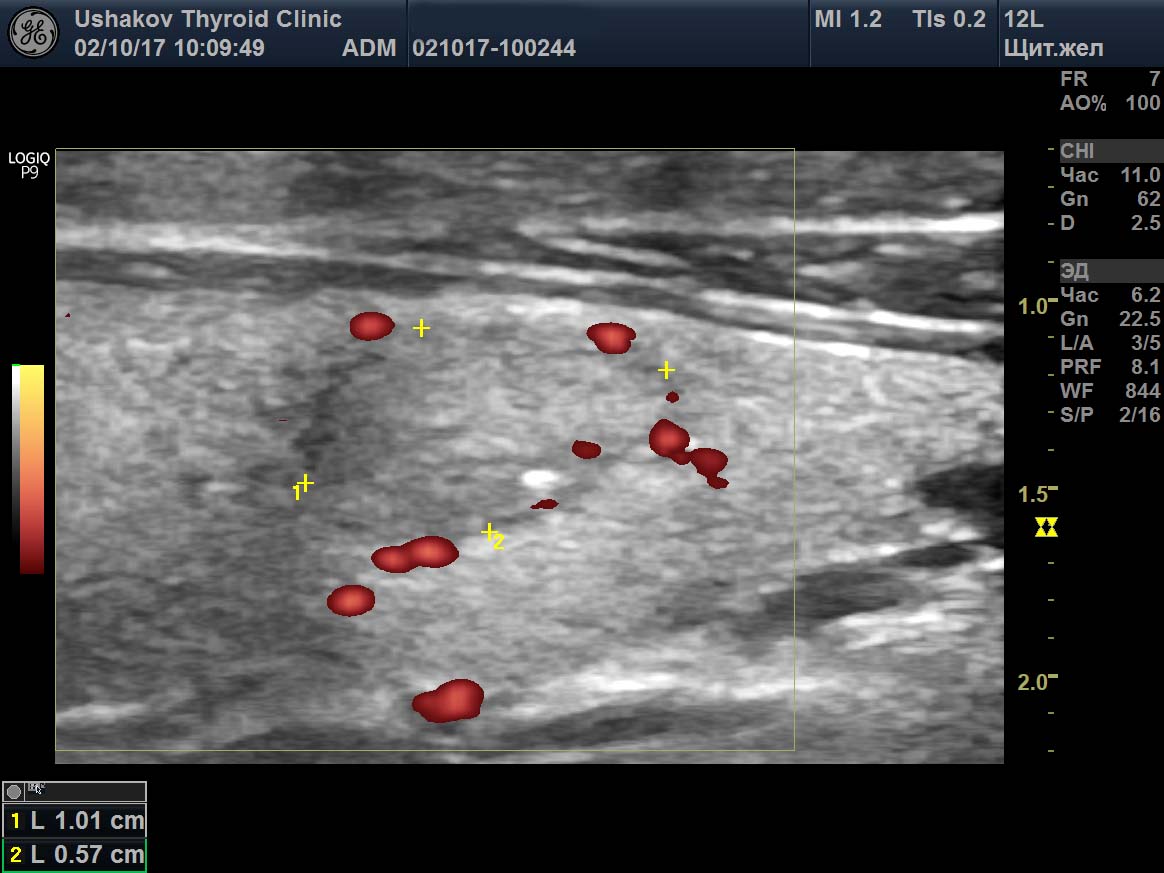 Перинодулярный кровоток узла щитовидной. Перинодулярный кровоток узла щитовидной железы что это такое. Интранодулярный кровоток узла. Кровоток на УЗИ.