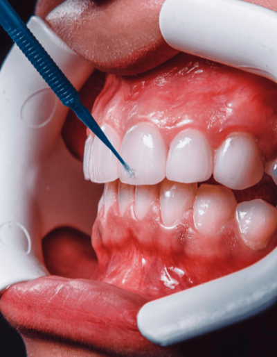 Этапы установки виниров зубов