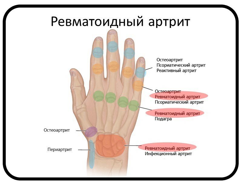 Признаки ревматоидного артрита