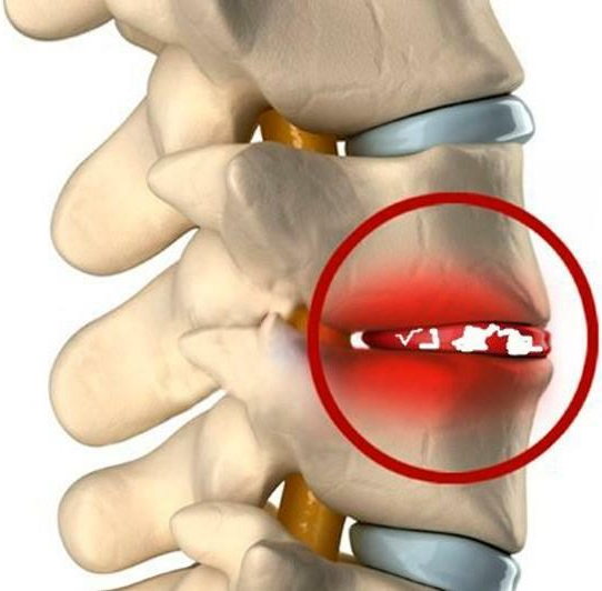 Спондилодисцит позвоночника: симптомы, причины и лечение
