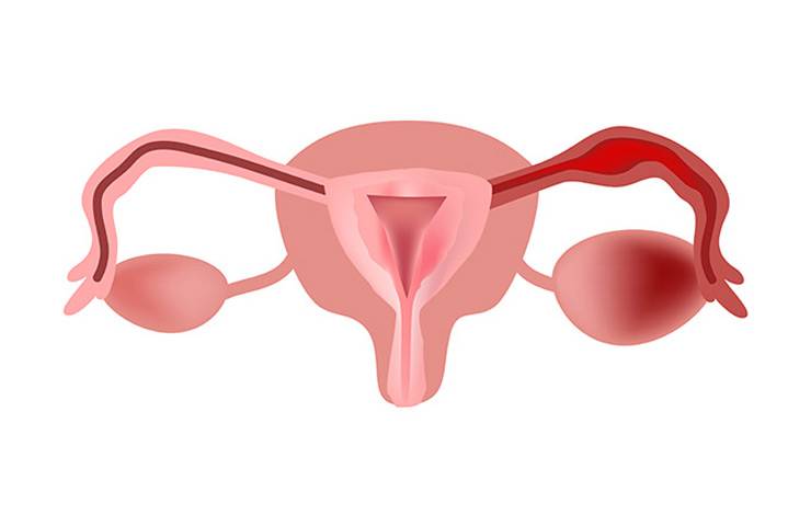 Воспаление маточных (фаллопиевых) труб