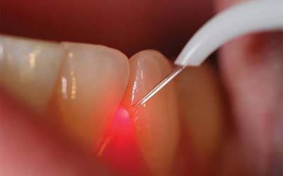 Киста зуба – лечение, симптомы