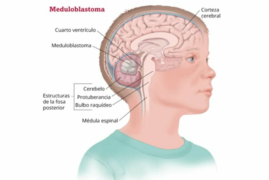 5 см мозга. Опухоль головного мозга мозжечка. Опухоль головного мозга у ребенка. Объёмное образование головного мозга задней черепной ямки.