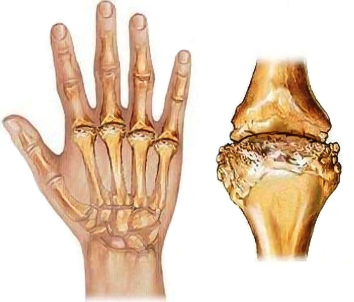 Артрид. Эрозивный ревматоидный артрит. Ревматоидный полиартрит кости.