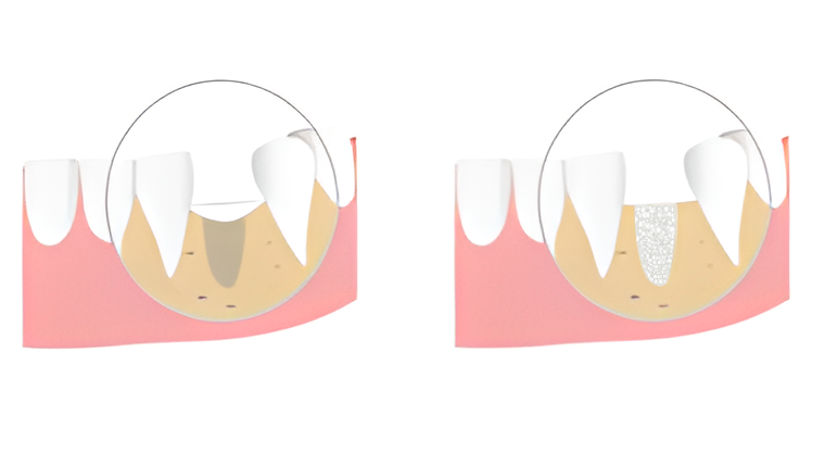 Костная пластика в стоматологии: виды и этапы проведения операции в Дербенте. Стоматология DK