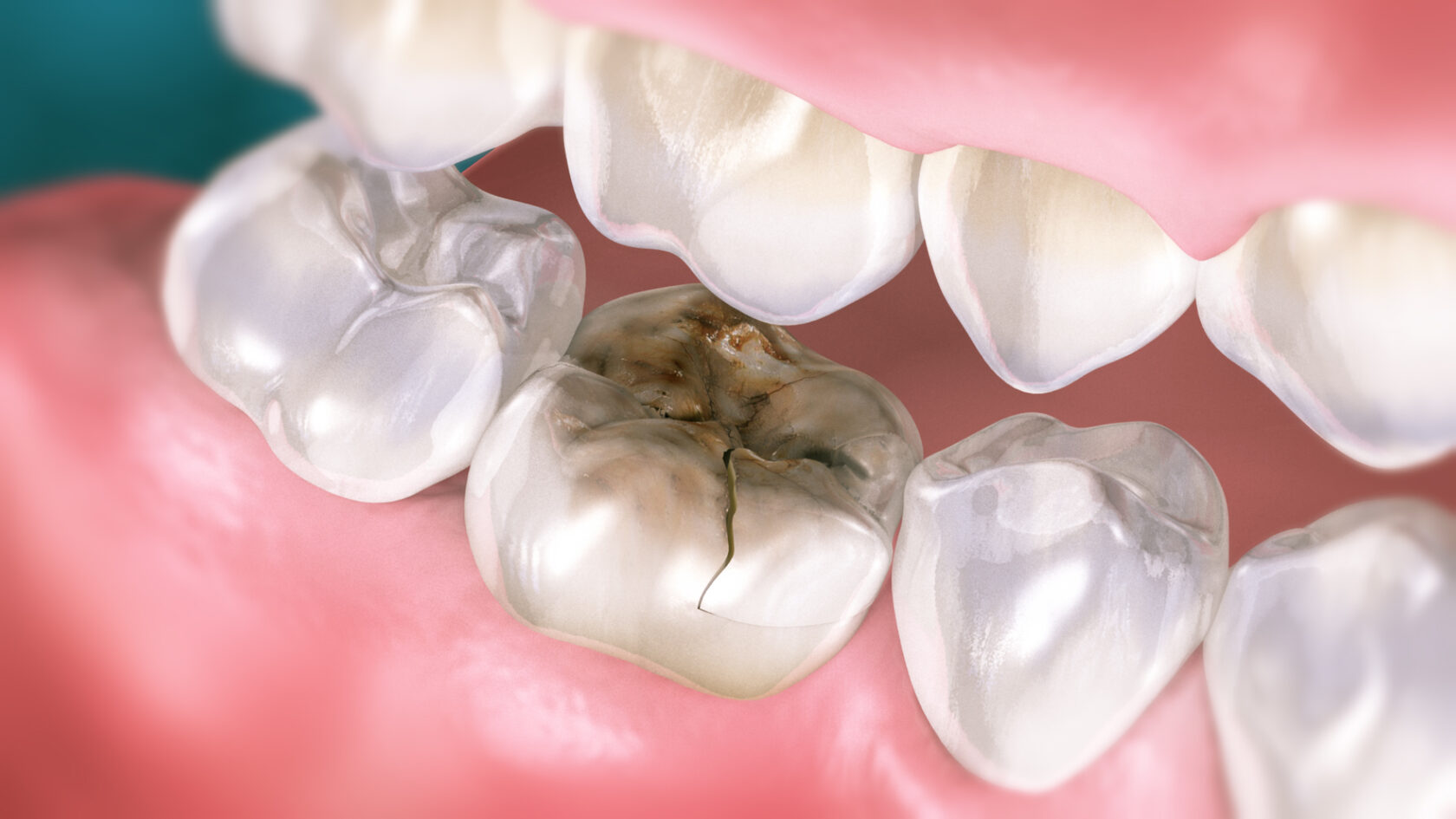 Как укрепить зубы и десны: причины пародонтоза у взрослых и детей